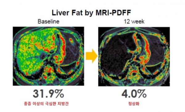 MRI-PDFF 검사로 확인한 지방간 감소 효과 (사진=한미약품)